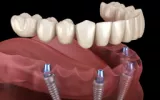  Dental Implant KL